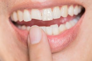 Diş kırılması tedavisi Kuşadası Aydın