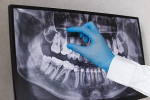 Diş hekimi x-ray üzerinde görünen kanal dolgusu yapılmış dişi gösteriyor