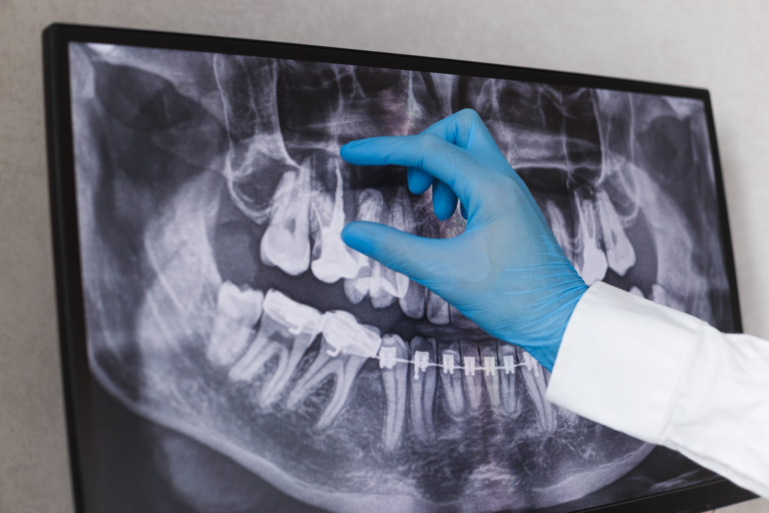 Diş hekimi x-ray üzerinde görünen kanal dolgusu yapılmış dişi gösteriyor