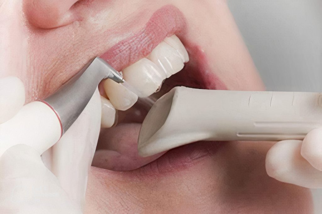 diş airflow uygulaması nedir ve nasıl yapılır, airflow diş temizleme